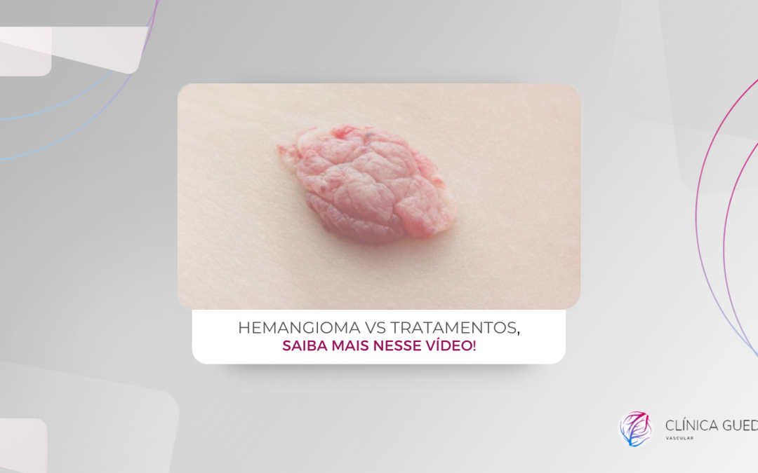 Hemangioma vs Tratamentos, saiba mais nesse vídeo!